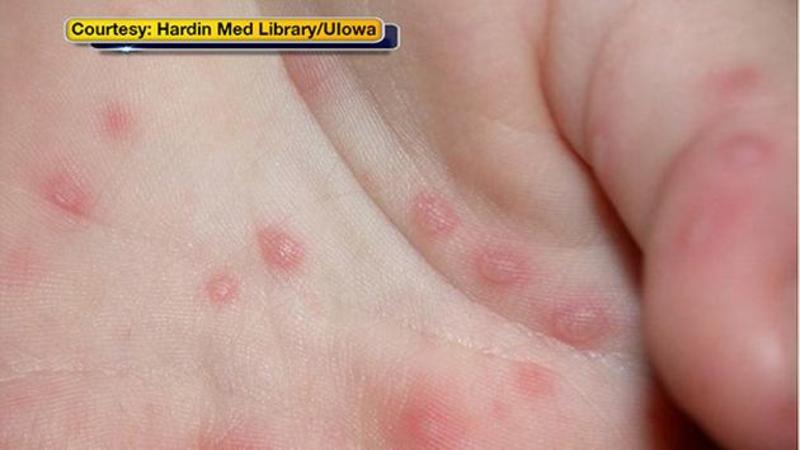 UNIVERSITY OF ILLINOIS REPORTS 60 CASES OF HAND, FOOT AND MOUTH DISEASE